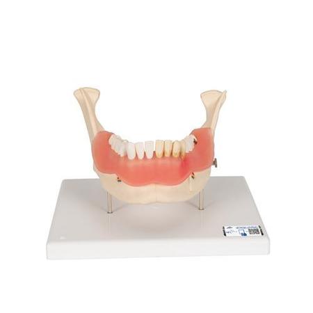 3B SCIENTIFIC Dental disease - w/ 3B Smart Anatomy 1000016